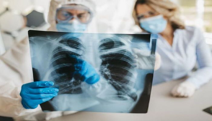 Azərbaycanda vərəm xəstələri üçün yeni ərzaq normaları tətbiq ediləcək