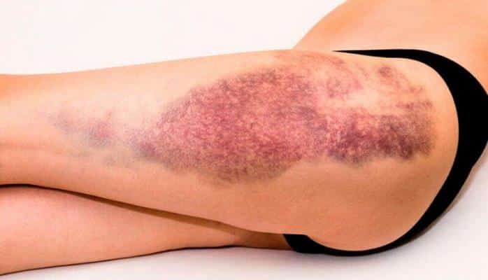 Hematoma və göyərmələrə qarşı effektiv vasitə - 1 günə aparır