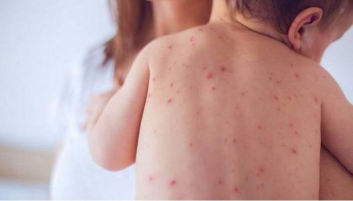 Bakıda sığınacaq əməkdaşları da qızılcaya yoluxdu