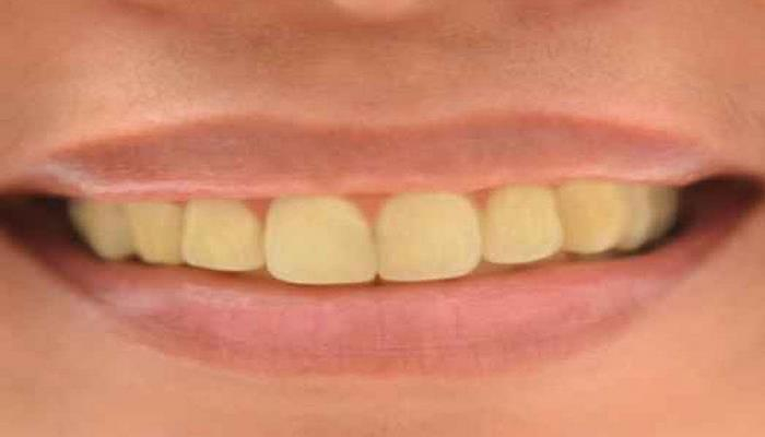 Dişlərin saralmasının 5 səbəbi