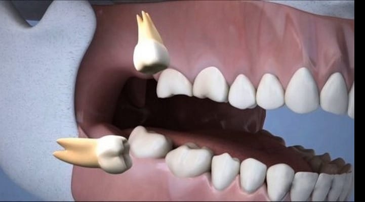 Стоматологи раскрыли, почему «не любят» зубы мудрости