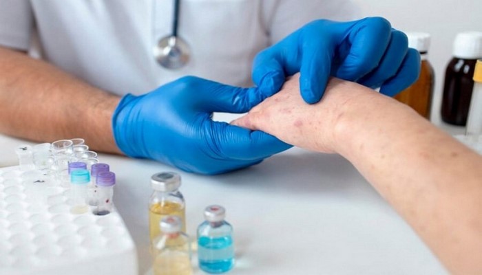 Cəlilabadda hazırda qızılcaya yoluxan 55 aktiv xəstə müalicə olunur