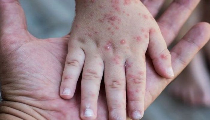 Cəlilabadda qızılcaya yoluxma ilə bağlı son vəziyyət AÇIQLANDI