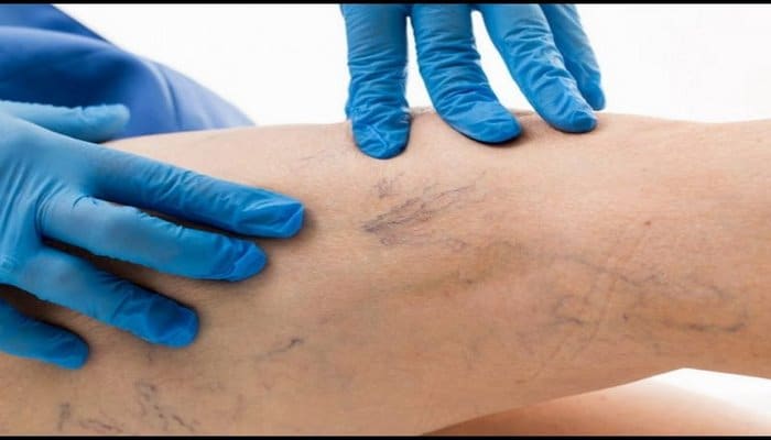 Damarlarda varikozun əlamətləri və qarşısının alınması haqqında mütəxəssis rəyi