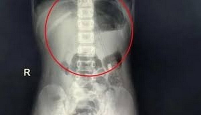 Çin’de 7 yaşındaki bir çocuğun boğazından 18 cm’lik kalem çıkartıldı