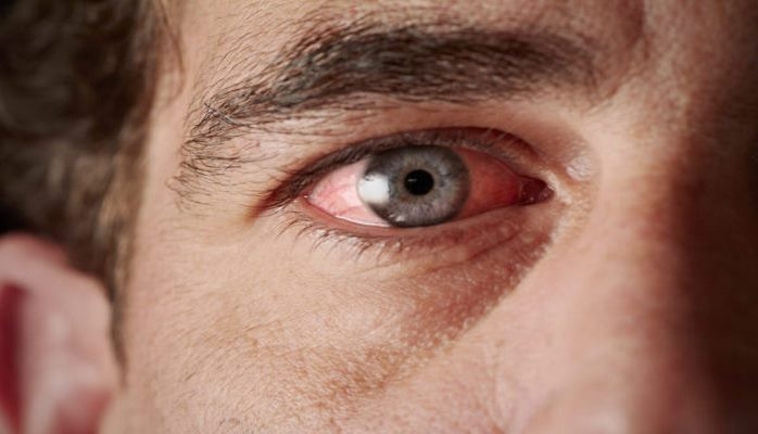 Глазные инфекции: виды, симптомы, лечение