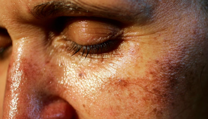 Dermatoloqlar inyeksiya ilə qaralma trendindən narahatdırlar