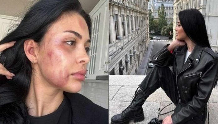 Döyülən model ölkədən qaçdı?