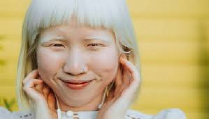 Albinoslar: Hər 70 min nəfərdən biri bu geni gizli daşıyır