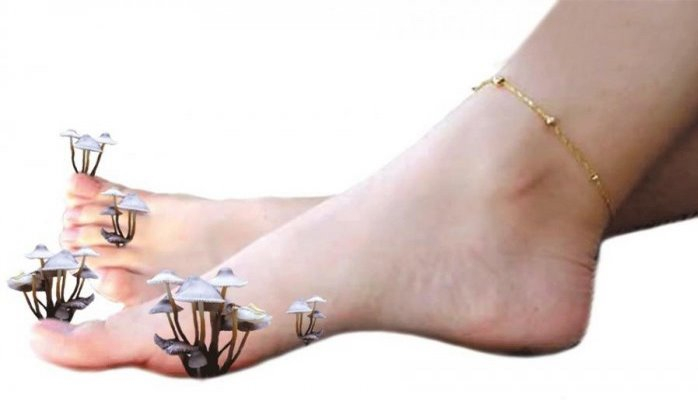 Ayaqda göbələkdən əziyyət çəkənlərə - Evdə müalicə üsulları