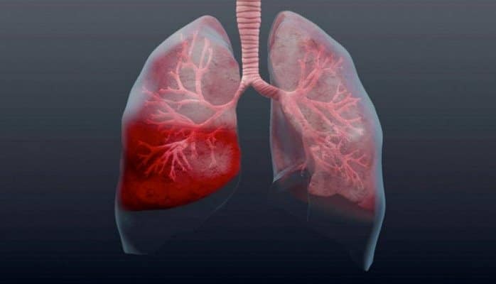 Pnevmoniya barədə 6 suala cavab – İnsanı öldürən xəstəliyin səbəbləri