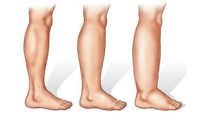 Ayaqların şişməsi hansı xəstəliyin əlamətidir?