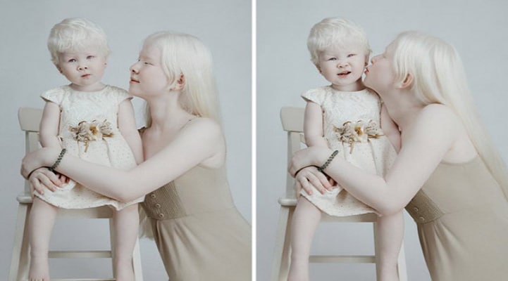 Model dünyasını fəth edən albinos bacılar