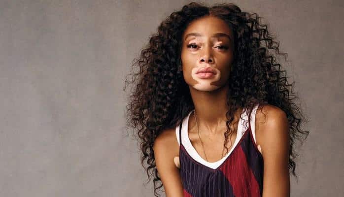 “Xəstəliyimə görə məni lağa qoyurdular”- Winnie Harlow