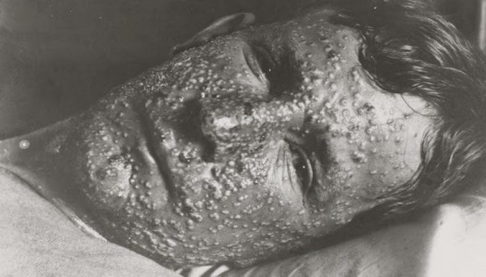 SSRİ-də qara çiçək epidemiyası cəmi 19 günə necə dəf edilib? - Tarixi fakt