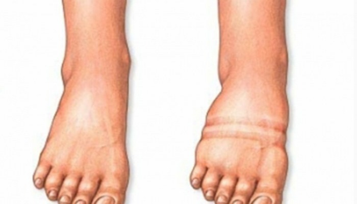 Ayaqlarda şiş yaranmasının səbəbləri nədir?