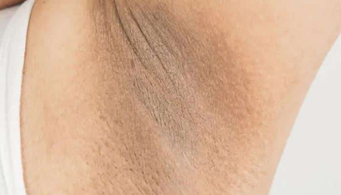 Qolaltı qaralmasını qarşı möcüzəvi məlhəm