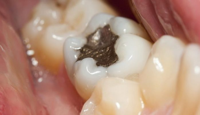 Diş ağrısının öhdəsindən necə gələ bilərik?