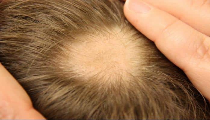 Alopecia areata (ocaqlı dazlıq)
