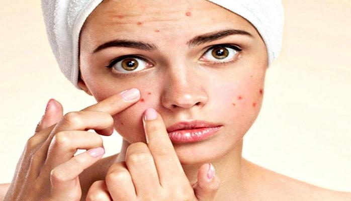 Üzdəki sızanaqlar xəstəlikdən xəbər verir