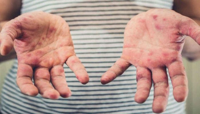 GEM: “Qızılca qeydə alınan siniflərdə şagirdlər tibbi müşahidəyə götürülür”