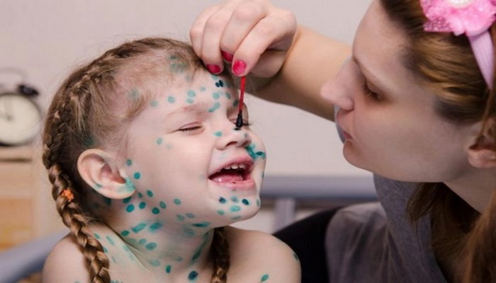 İnsanların əksəriyyəti çiçək xəstəliyi qarşısında acızdir