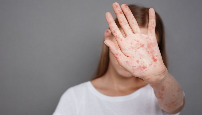 Məktəblərdə qızılca ilə bağlı son vəziyyət açıqlanıb