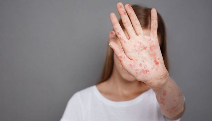 Ötən il Azərbaycanda 8 minə yaxın qızılcaya şübhəli xəstə aşkar edilib