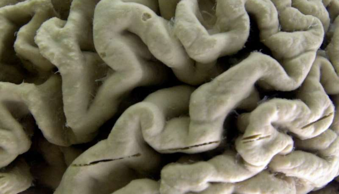 Qan analizi Alzheimer xəstəliyi riskini illər öncədən müəyyən edə bilər