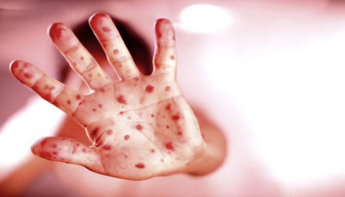 Qızılca hansı xəstəliklərlə səhv salınır?