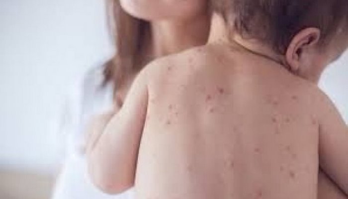 Qızılca yenə can aldı - Virus Azərbaycandan nə vaxt “çıxacaq”?