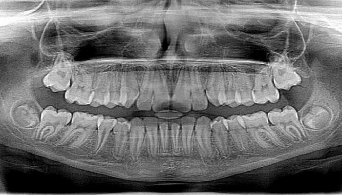 Рентгенография полости рта может выявить хроническое заболевание коронарной артерии
