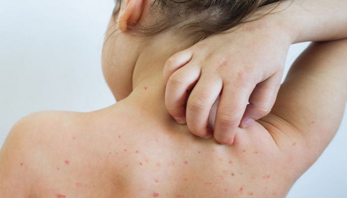 Səbinə Cəfərova: “Qızılca və xəstəliyin ötürülməsinin qarşısını almağın ən effektiv yolu vaksindir” - MÜSAHİBƏ