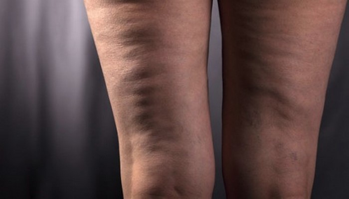 Врачи назвали эффективные способы избавления от целлюлита